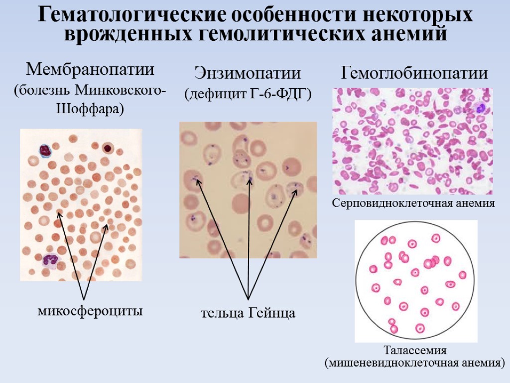Тельца гейнца. Гемолитическая анемия картина крови. Болезнь Шоффара-Минковского анемия. Картина крови при приобретенной гемолитической анемии. Наследственный микросфероцитоз (болезнь Минковского-Шоффара).