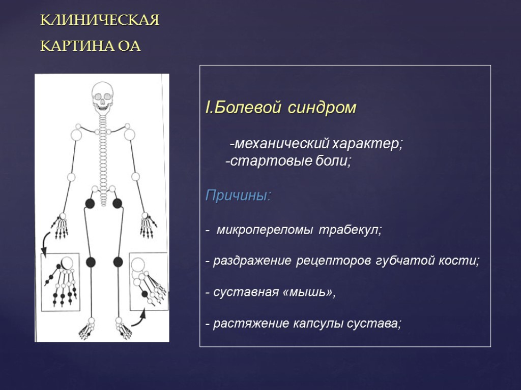 Механический характер. Болевой синдром при ревматоидном артрите. Ведущий синдром при ревматоидном артрите. Синдромы при остеоартрозе.