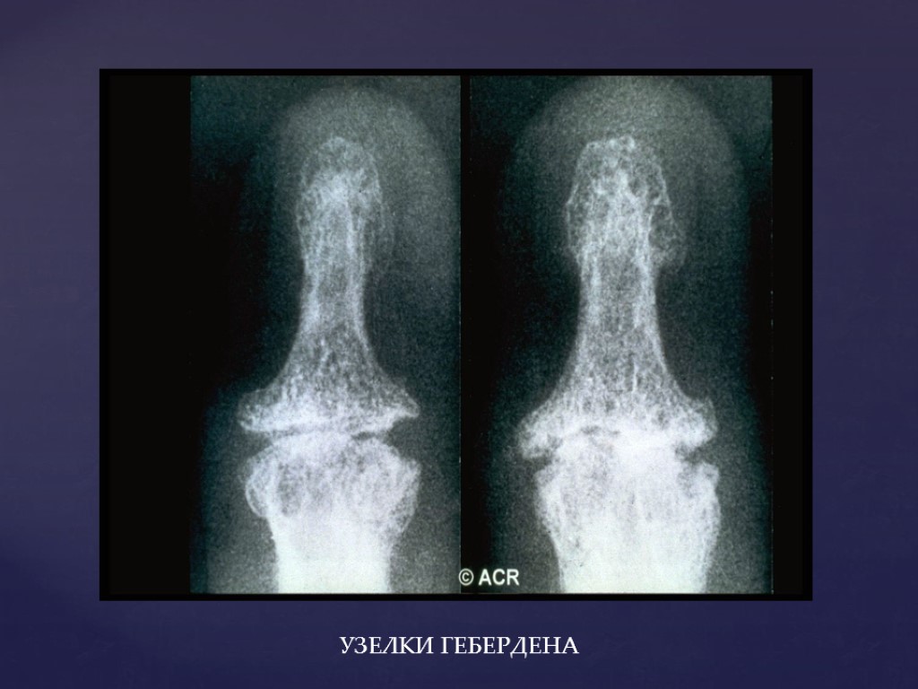 Узелки бушара лечение. Остеоартроз узлы Гебердена. Гебердена узелки Гебердена. Узелки Гебердена ревматоидный артрит. Геберденовские узелки подагра.