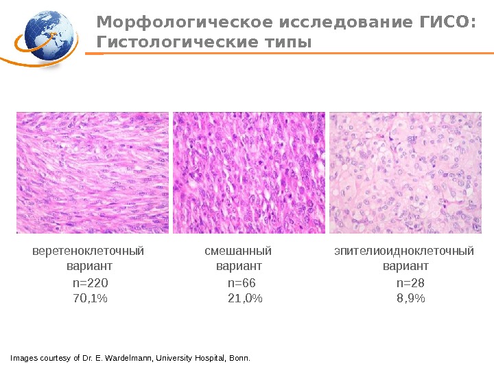 Морфологическое исследование ГИСО :  Гистологические типы веретеноклеточный  смешанный    эпителиоидноклеточный  вариант