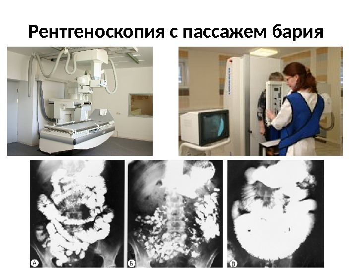 Рентгеноскопия с пассажем бария 