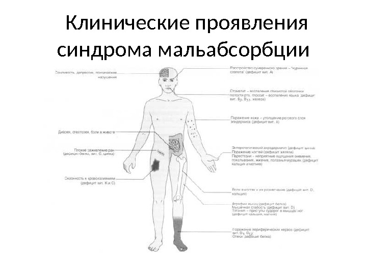  Клинические проявления синдрома мальабсорбции 