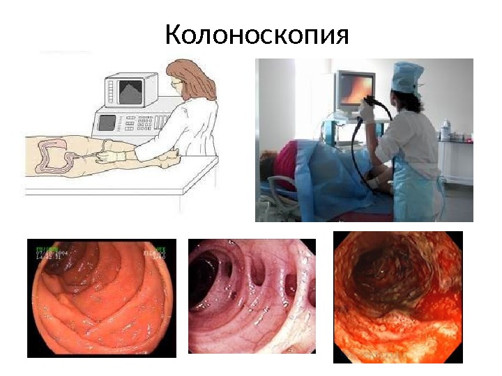 Колоноскопия 