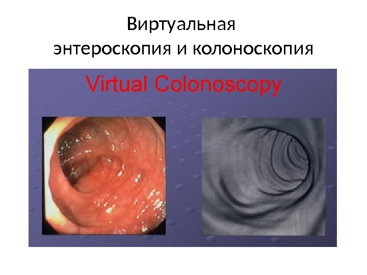 Виртуальная энтероскопия и колоноскопия 