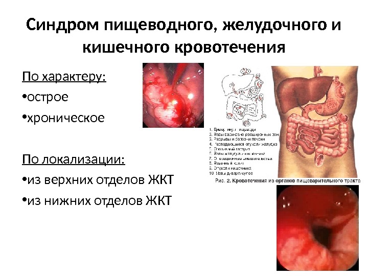 Синдром пищеводного, желудочного и кишечного кровотечения По характеру:  • острое • хроническое По локализации: 