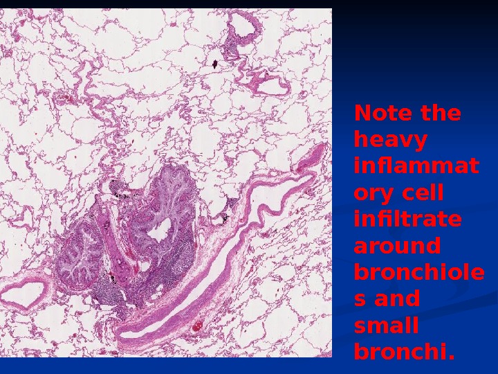 Note the heavy inflammat ory cell infiltrate around bronchiole s and small bronchi. 