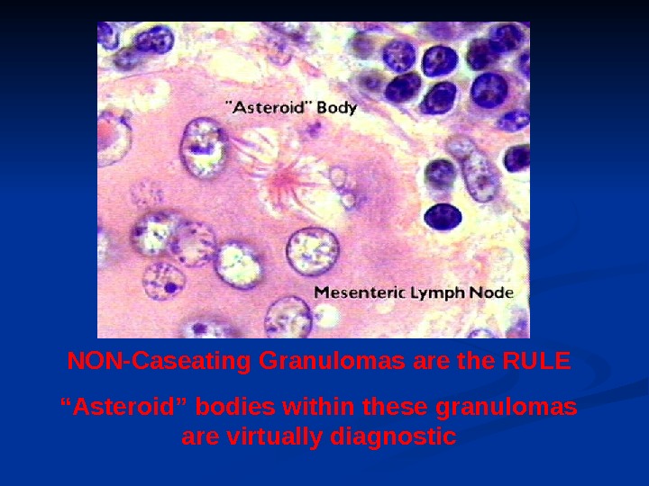 NON-Caseating Granulomas are the RULE “ Asteroid” bodies within these granulomas are virtually diagnostic 