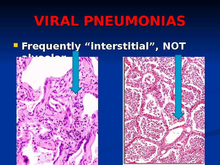 VIRAL PNEUMONIAS Frequently “interstitial”, NOT alveolar 