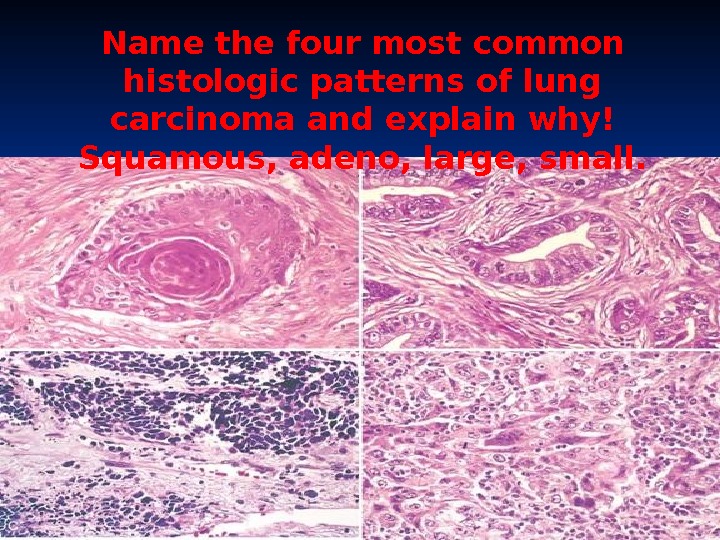 Name the four most common histologic patterns of lung carcinoma and explain why! Squamous, adeno, large,