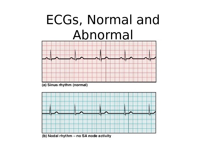 ECGs, Normal and Abnormal 