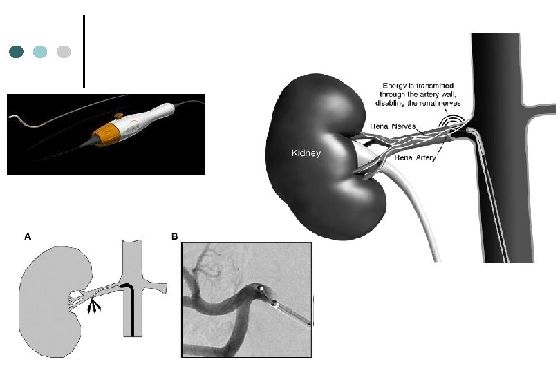 Renal denervation system Денервация почечных артерий 