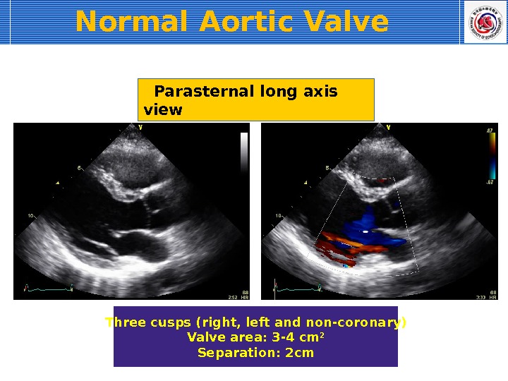 Normal Aortic Valve Parasternal long axis view Three cusps (right, left and non-coronary) Valve area: 3