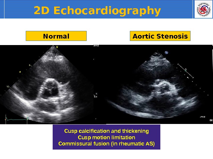 Normal Aortic Stenosis Cusp calcification and thickening Cusp motion limitation Commissural fusion (in rheumatic AS)2 D