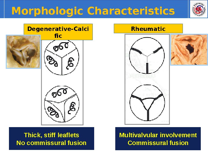 Morphologic Characteristics  Degenerative-Calci fic Rheumatic Thick, stiff leaflets No commissural fusion Multivalvular involvement Commissural fusion