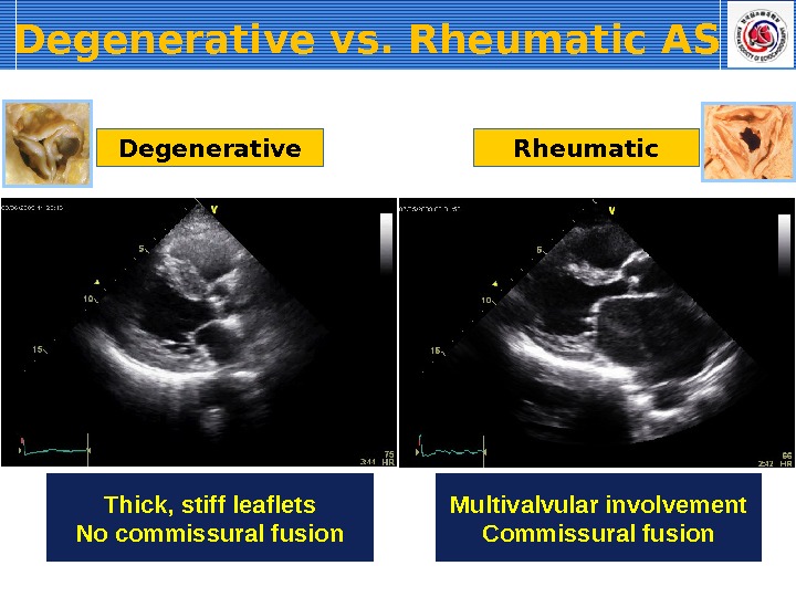 Degenerative vs. Rheumatic AS Thick, stiff leaflets No commissural fusion Degenerative Rheumatic Multivalvular involvement Commissural fusion