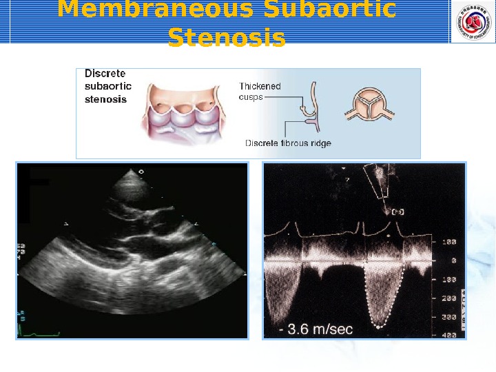 Membraneous Subaortic Stenosis 