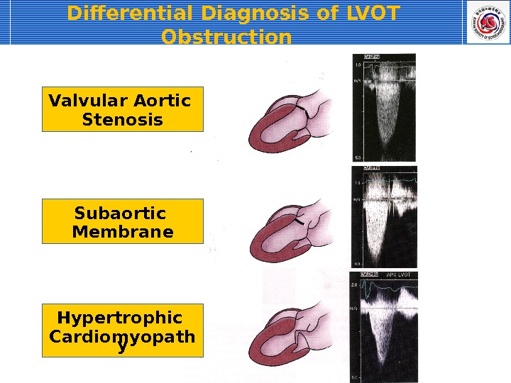 Differential Diagnosis of LVOT Obstruction  Valvular Aortic Stenosis Subaortic Membrane Hypertrophic Cardiomyopath y 