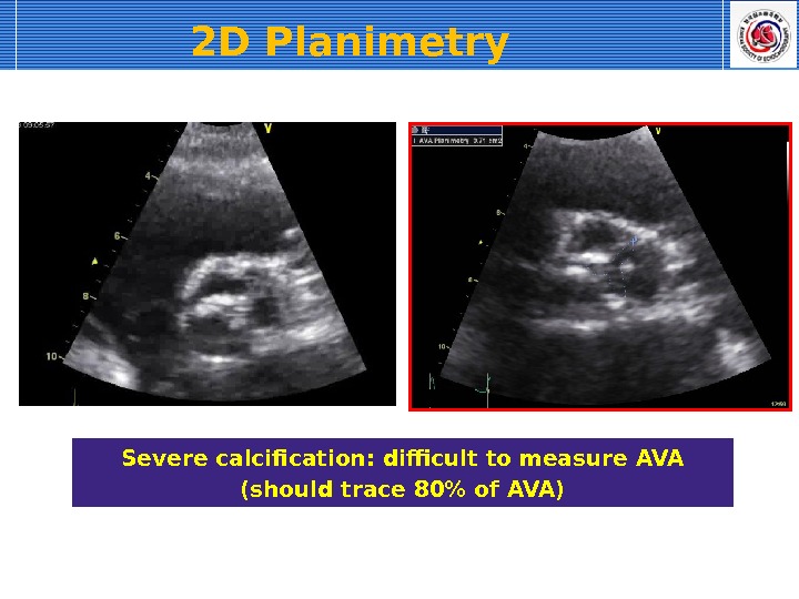 2 D Planimetry  Severe calcification: difficult to measure AVA (should trace 80 of AVA) 