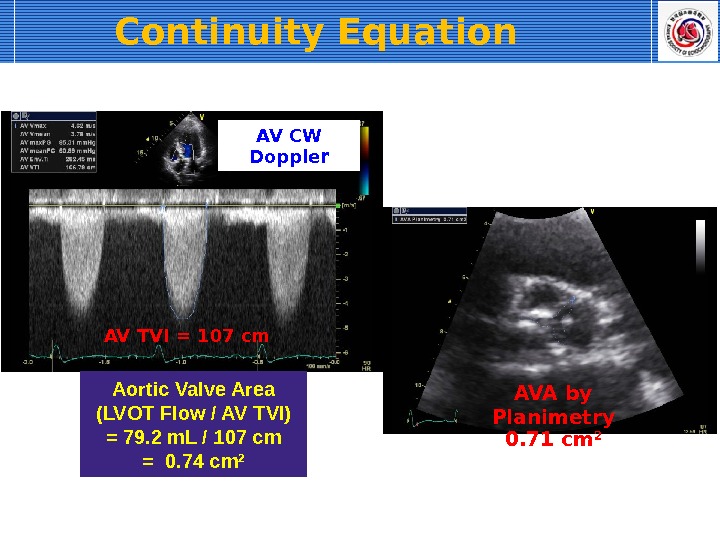AV TVI = 107 cm Aortic Valve Area (LVOT Flow / AV TVI) = 79. 2