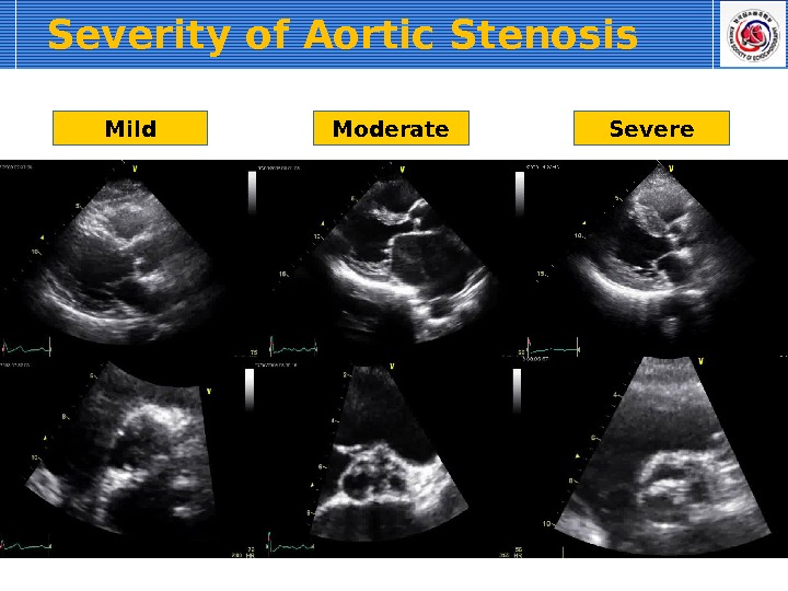 Severity of Aortic Stenosis  Mild Moderate Severe 