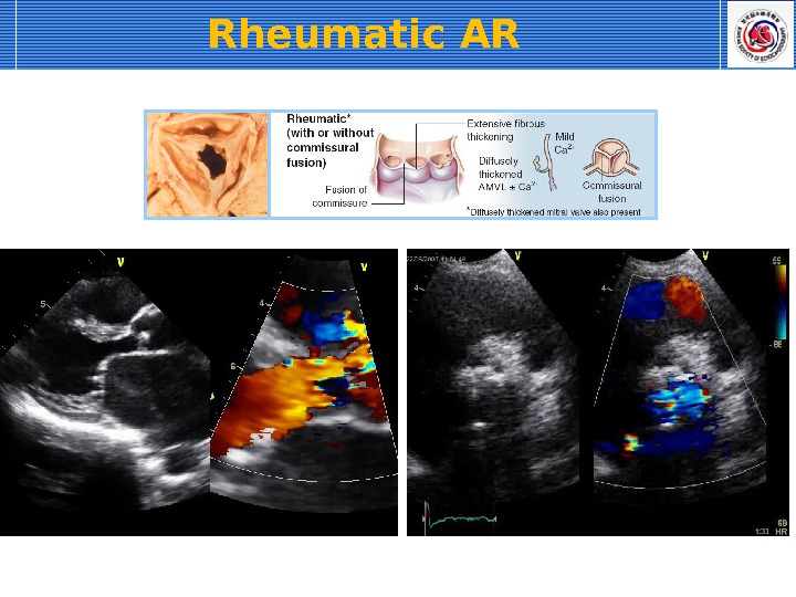 Rheumatic AR 