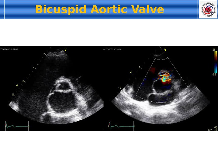 Bicuspid Aortic Valve 