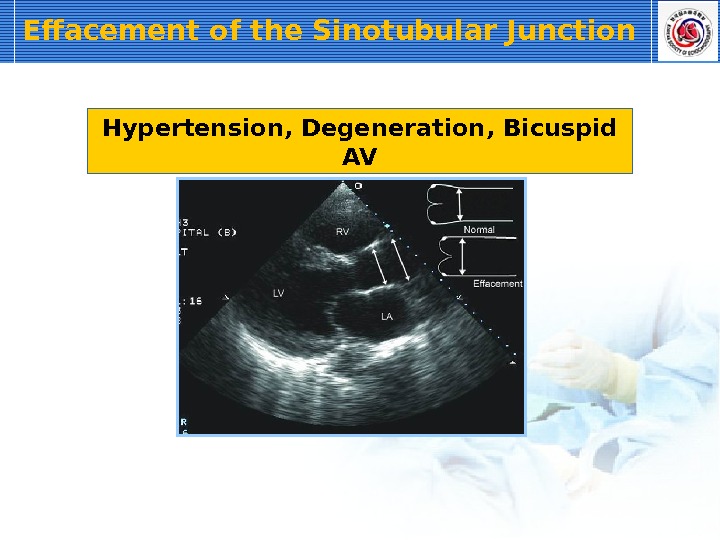 Effacement of the Sinotubular Junction Hypertension, Degeneration, Bicuspid AV 