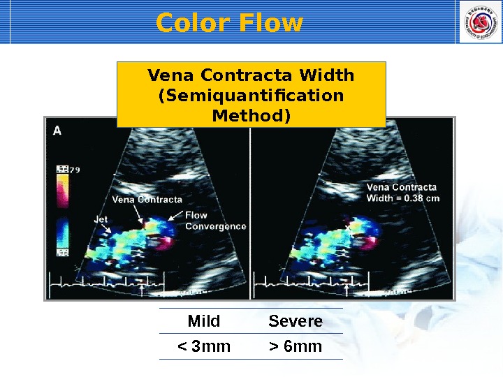 Mild Severe  3 mm  6 mm. Vena Contracta Width (Semiquantification Method)Color Flow 