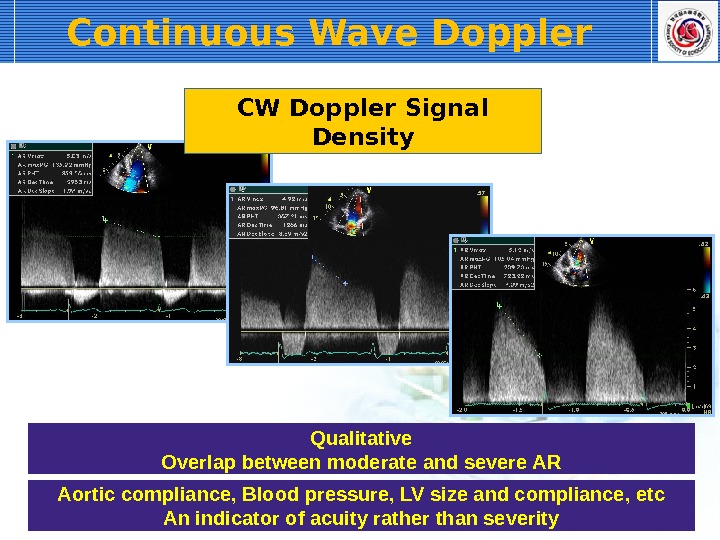 Continuous Wave Doppler CW Doppler Signal Density Qualitative Overlap between moderate and severe AR Aortic compliance,