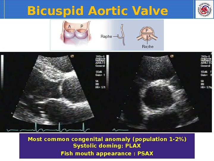 Bicuspid Aortic Valve Most common congenital anomaly (population 1 -2) Systolic doming: PLAX Fish mouth appearance