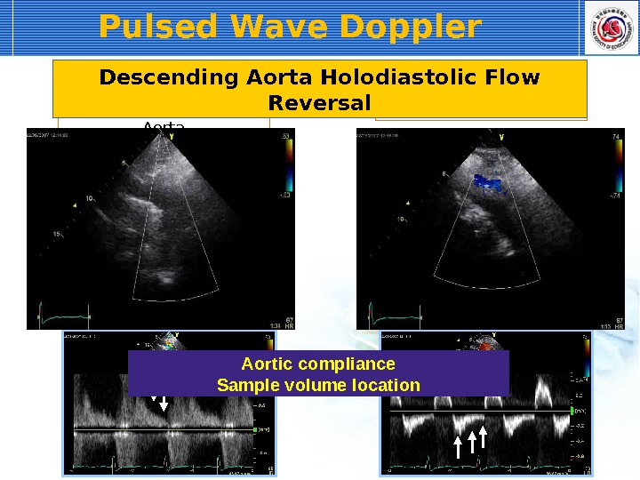 Pulsed Wave Doppler Descending Thoracic Aorta Abdominal Aorta. Descending Aorta Holodiastolic Flow Reversal Aortic compliance Sample