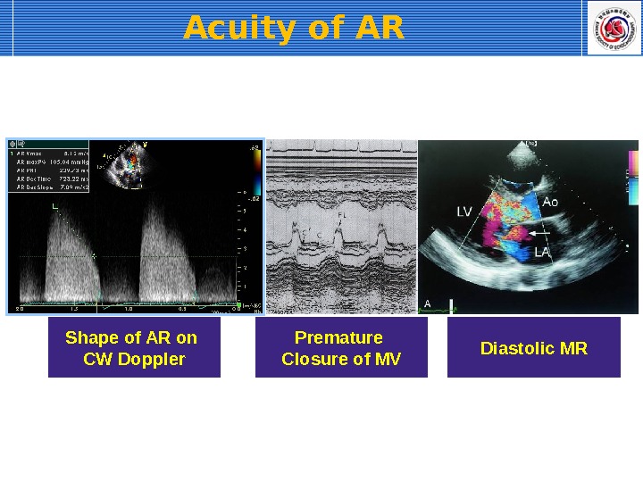 Acuity of AR Shape of AR on CW Doppler Premature Closure of MV Diastolic MR 