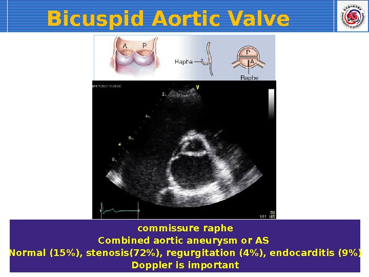 commissure raphe Combined aortic aneurysm or AS Normal (15), stenosis(72), regurgitation (4), endocarditis (9) Doppler is