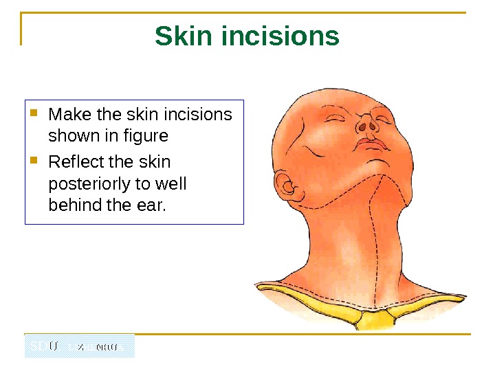  SDU.  LIZHENHUA Skin incisions Make the skin incisions shown in figure  Reflect
