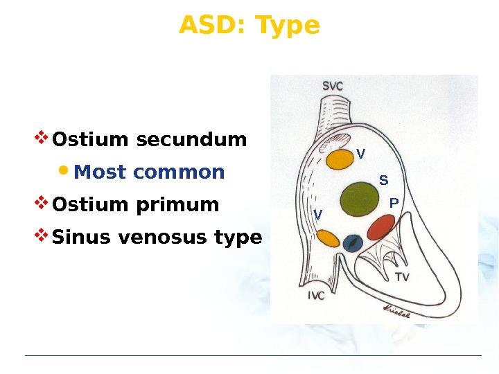 ASD: Type S PV V Ostium secundum Most common Ostium primum Sinus venosus type 