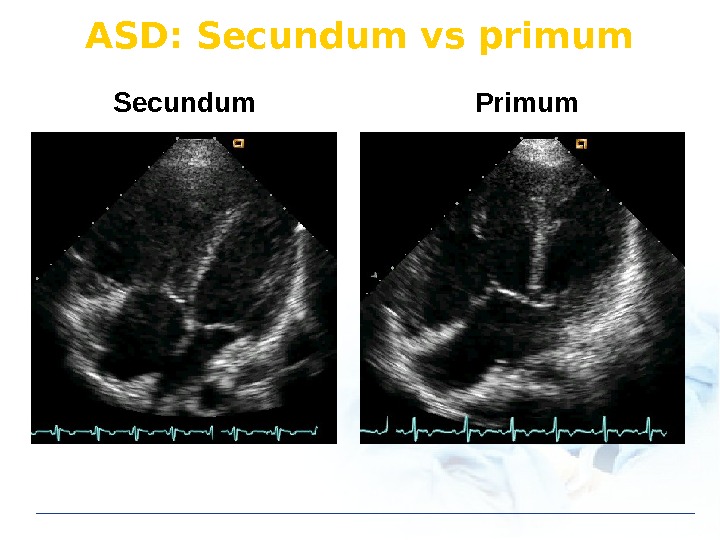 ASD: Secundum vs primum Secundum Primum 