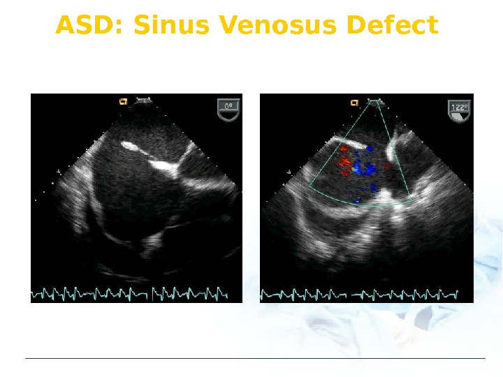 ASD: Sinus Venosus Defect 