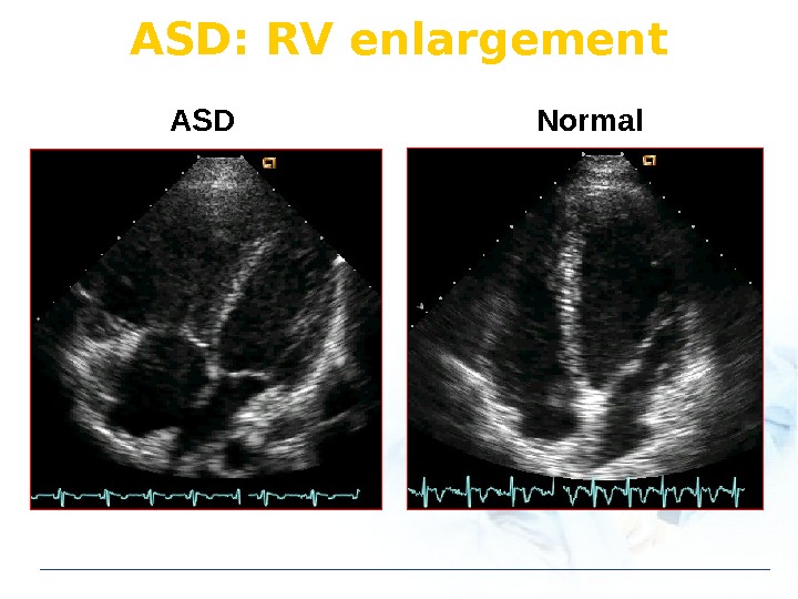 ASD Normal. ASD: RV enlargement 