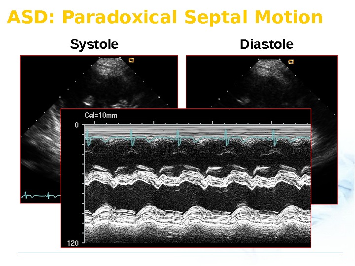 ASD: Paradoxical Septal Motion Systole Diastole 