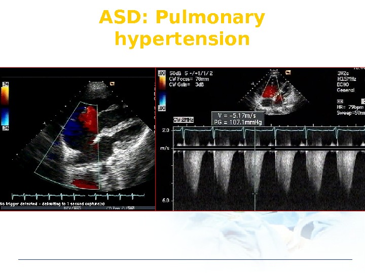 ASD: Pulmonary hypertension 
