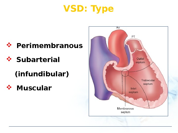 VSD: Type Perimembranous Subarterial (infundibular) Muscular 