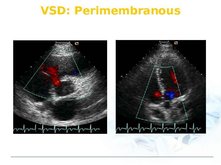 VSD: Perimembranous 