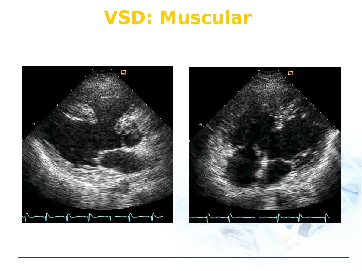 VSD: Muscular 