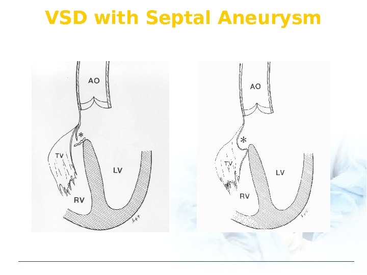 VSD with Septal Aneurysm 
