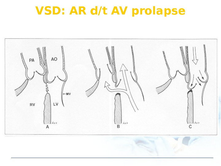 VSD: AR d/t AV prolapse 