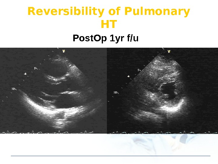 Reversibility of Pulmonary HT Post. Op 1 yr f/u 