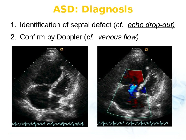 ASD: Diagnosis 1. Identification of septal defect ( cf.  echo drop-out) 2. Confirm by Doppler
