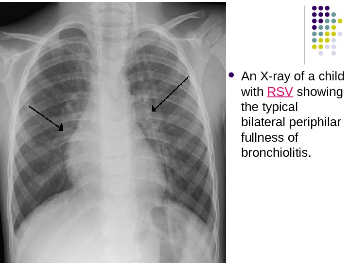  An X-ray of a child with RSV showing the typical bilateral periphilar  fullness of