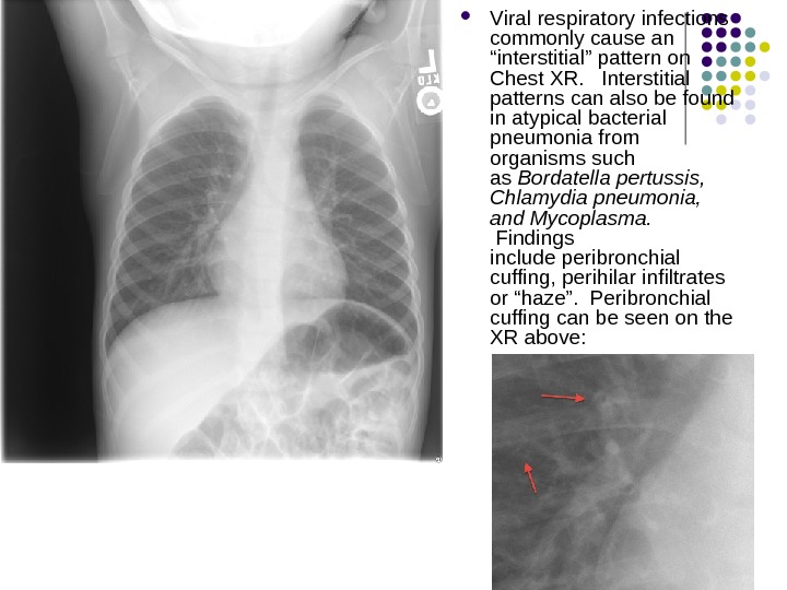  V iral respiratory infections commonly cause an “interstitial” pattern on Chest XR.  Interstitial patterns