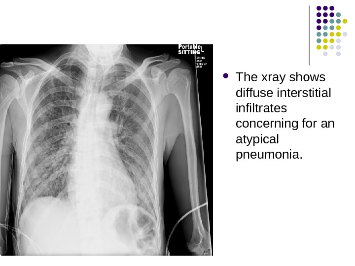  The xray shows diffuse interstitial infiltrates concerning for an atypical pneumonia. 